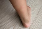 What is Filariasis? Types, Symptoms, Ways to Prevent  and Control Filariasis
