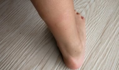 What is Filariasis? Types, Symptoms, Ways to Prevent  and Control Filariasis